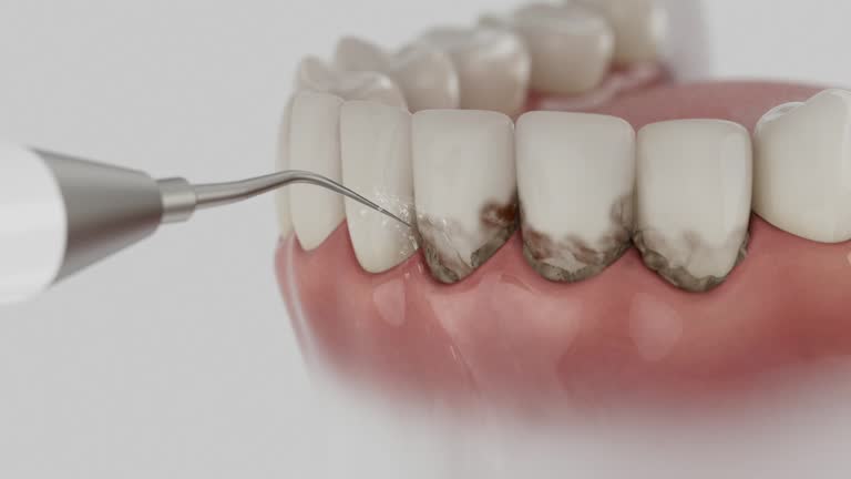 Reliable Tooth Extraction contractor in Naperville, IL by Smile Center Dentistry